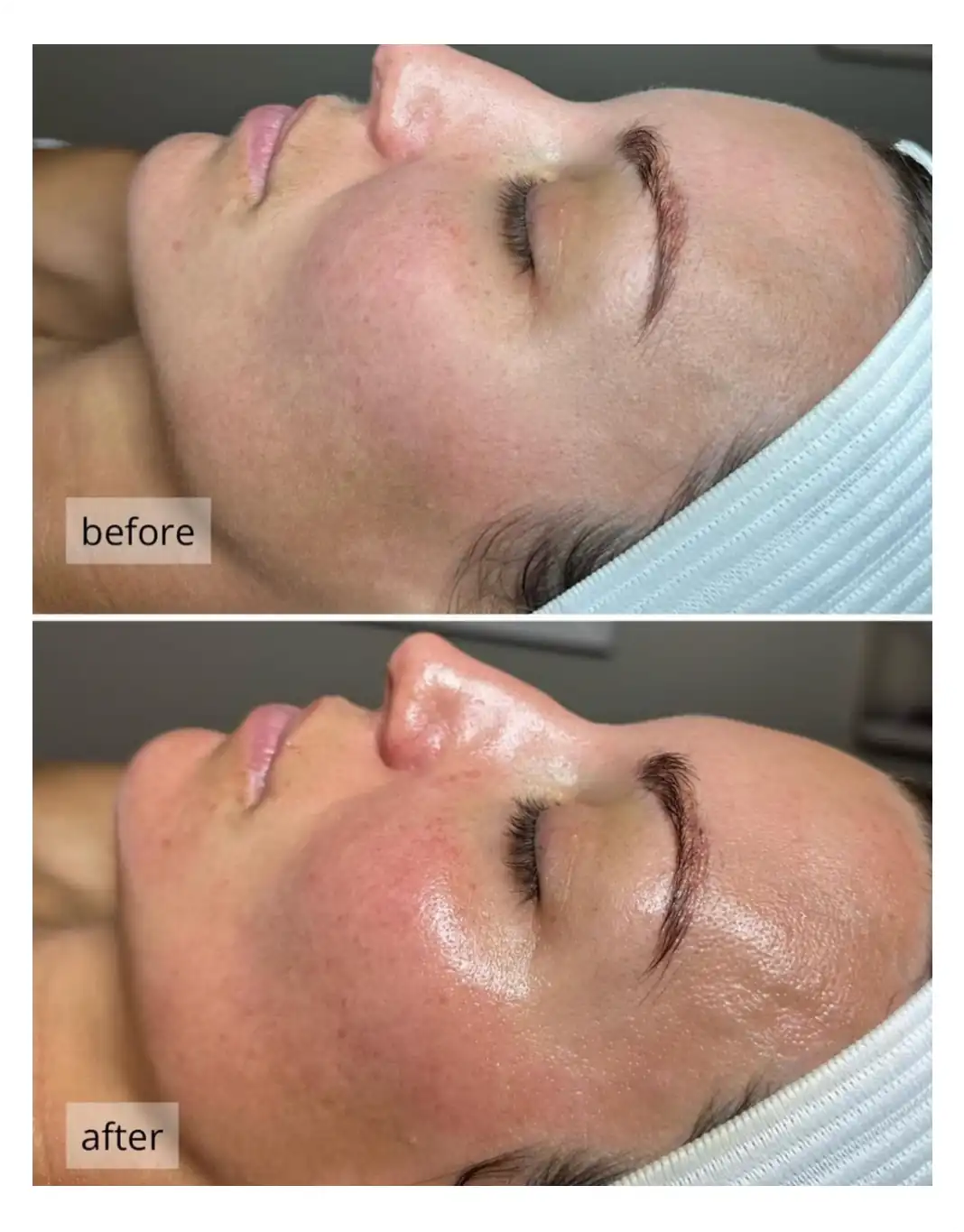 before and after image of DiamondGlow treatment