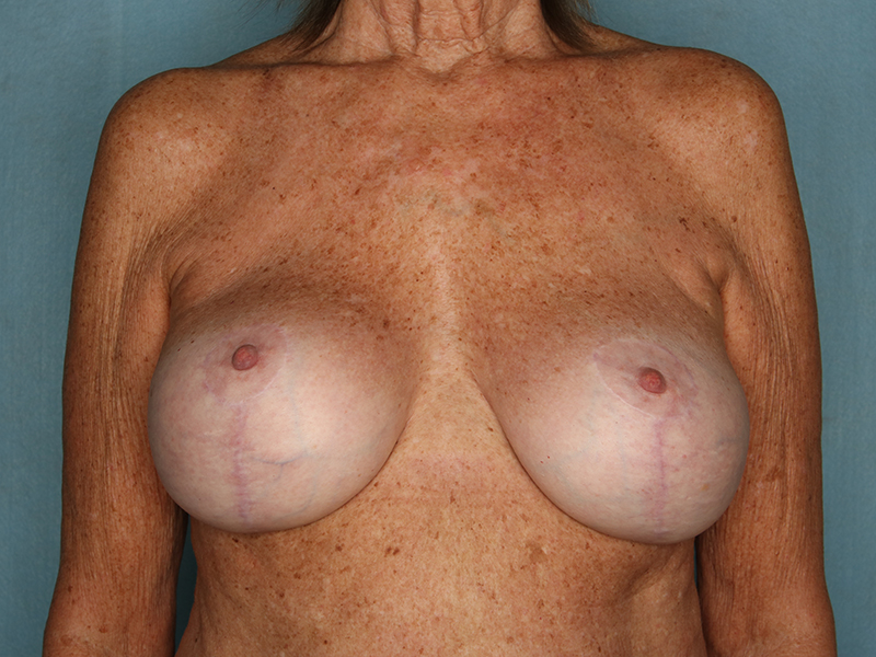 Breast Revision Before and After | Kiran Gill MD