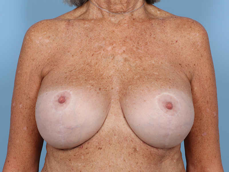 Breast Revision Before and After | Kiran Gill MD