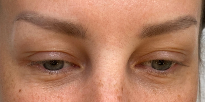 Permanent Makeup Before and After | Kiran Gill MD